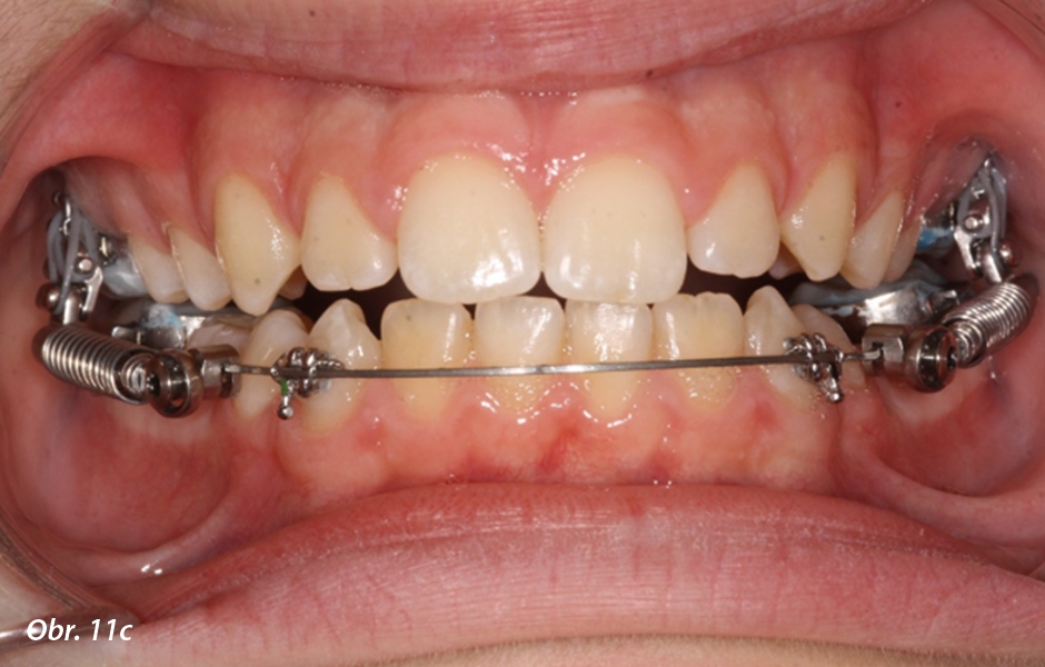 Moderní ortodoncie pro nespolupracující pacienty / „SARA® Concept“
