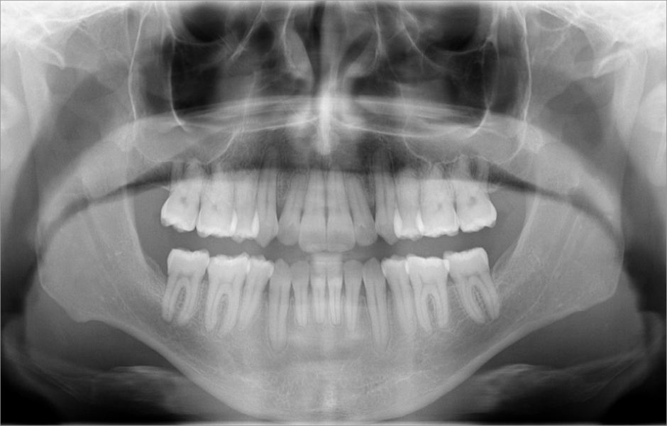 Obr. 9: Ortopantomogram po léčbě.