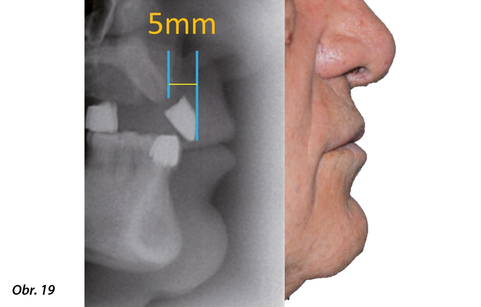 Bezzubý oblouk horní čelisti: Kritéria pro výběr implantátem kotvené náhrady
