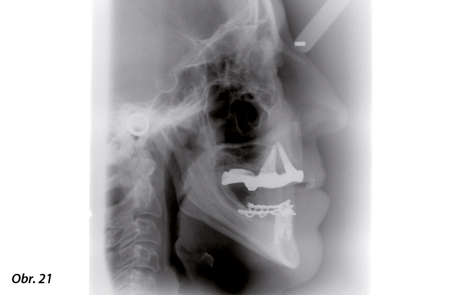Bezzubý oblouk horní čelisti: Kritéria pro výběr implantátem kotvené náhrady