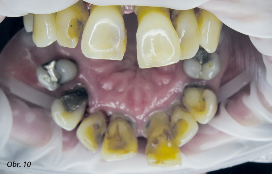 Detailní pohled na palatinální plošky zubů horního frontálního úseku.
