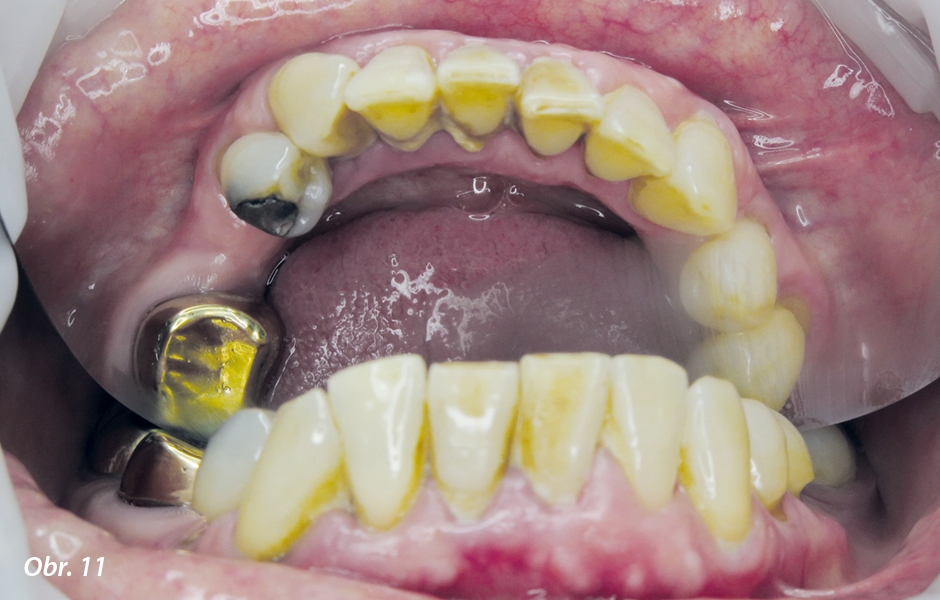 Detailní pohled na lingvální plošky zubů dolního frontálního úseku.