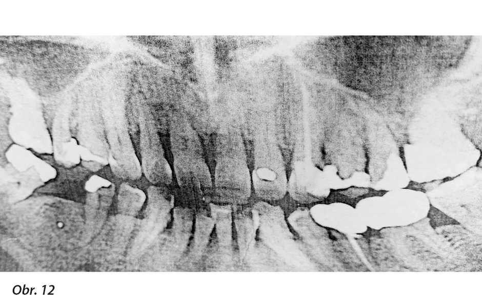 Ortopantomogram pacientky