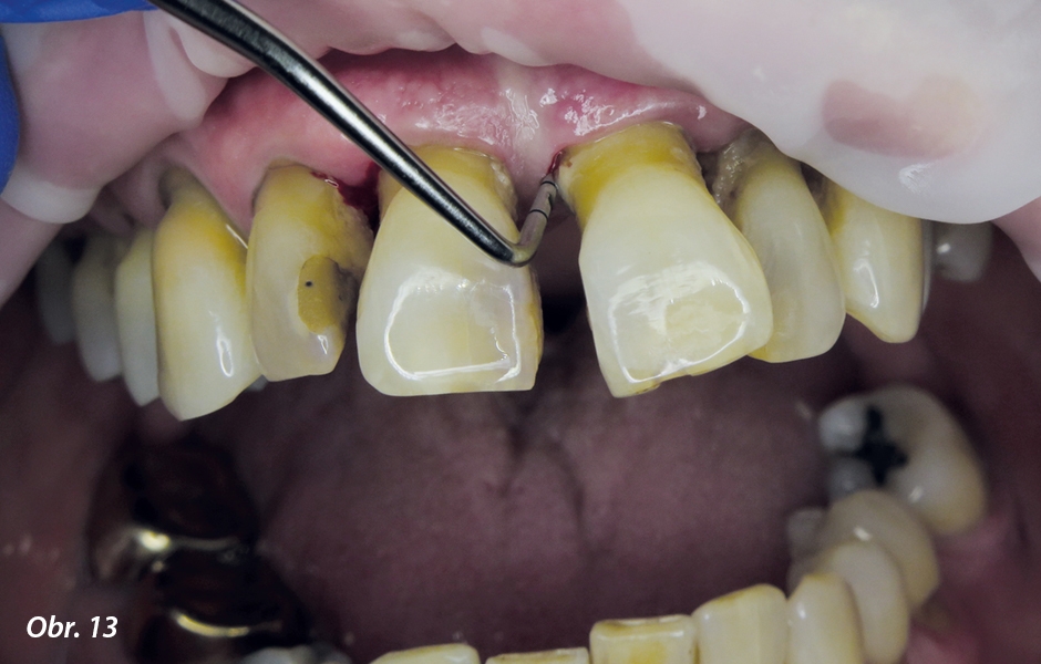 Sondáž aktivní parodontální kapsy na meziální plošce zubu 21