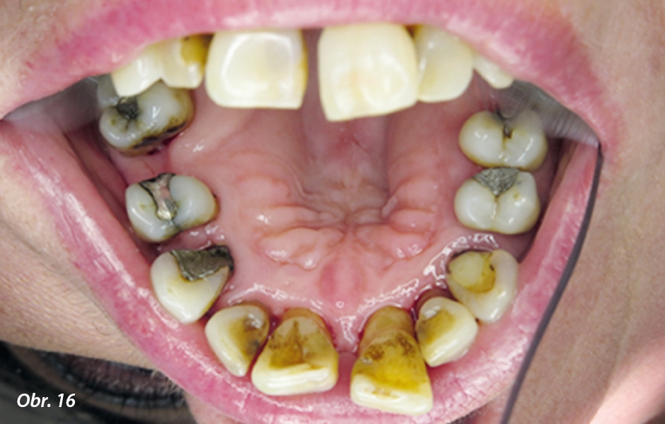 Detailní pohled na palatinální plošky zubů horního frontálního úseku při 2. kontrolní návštěvě