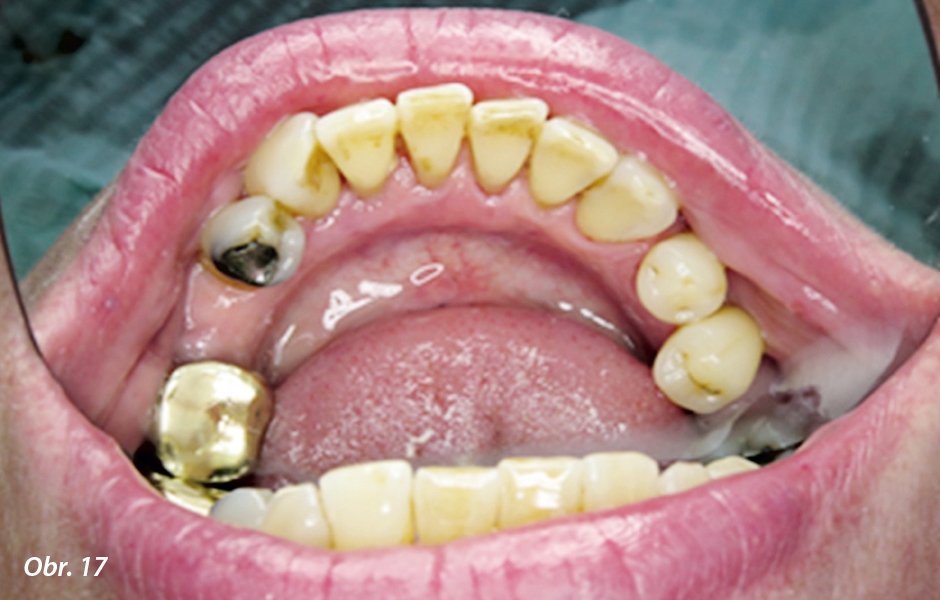 Detailní pohled na lingvální plošky zubů dolního frontálního úseku při 2. kontrolní návštěvě
