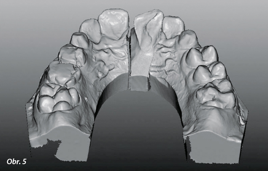 Obnažená linie lomu z palatinální strany po gingivektomii na virtuálním modelu