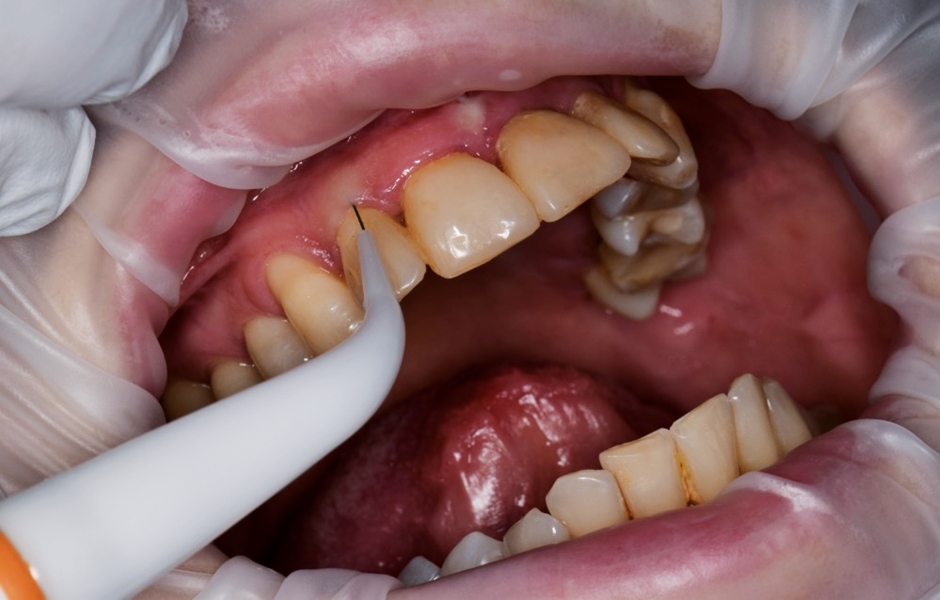 Použití sondy v ústech pacienta