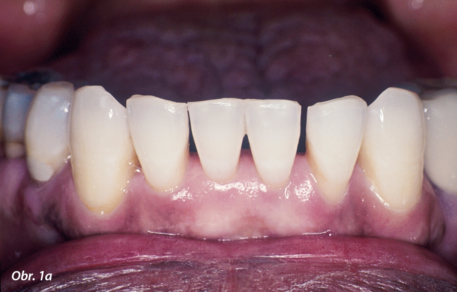 Fotografie před ošetřením: dolní frontální zuby s mobilitou 2. stupně: a) Labiální pohled
