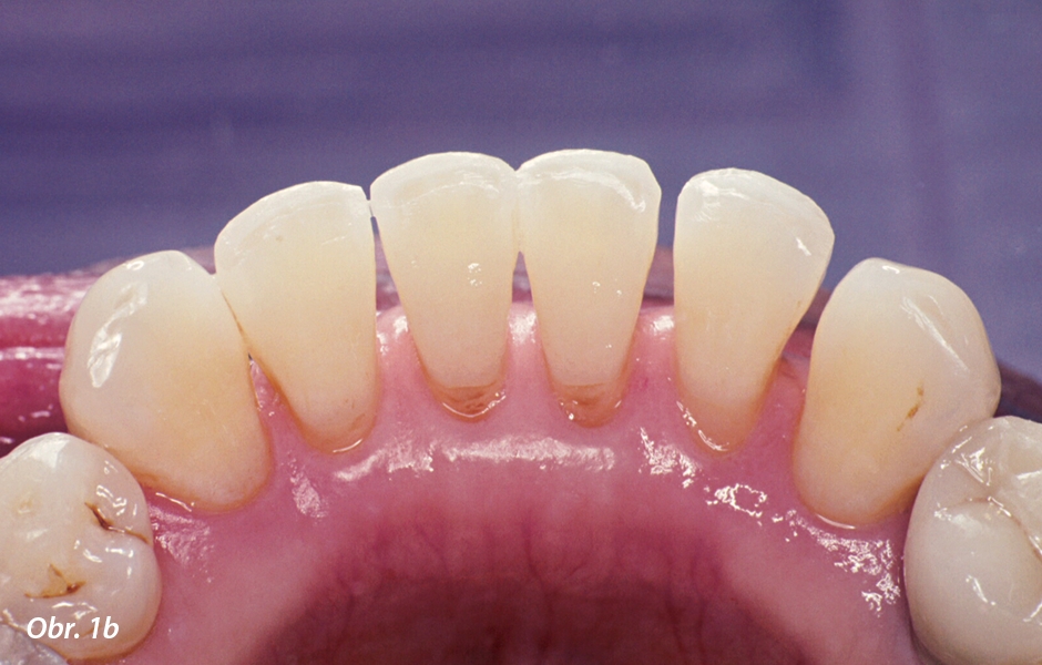 Fotografie před ošetřením: dolní frontální zuby s mobilitou 2. stupně: b) Lingvální pohled