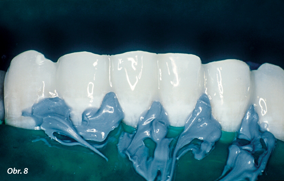 Labiální aproximální plošky po vytvarování kompozitní pryskyřice a vytvrzení světlem. Tato kompozitní pryskyřice stabilizuje zuby, zatímco dlaha z pásku Ribbond se umístí na lingvální povrch zubů.