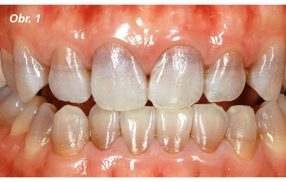 První případ – silně diskolorované zuby rekonstruované pomocí keramických fazet (IPS e.max Press)