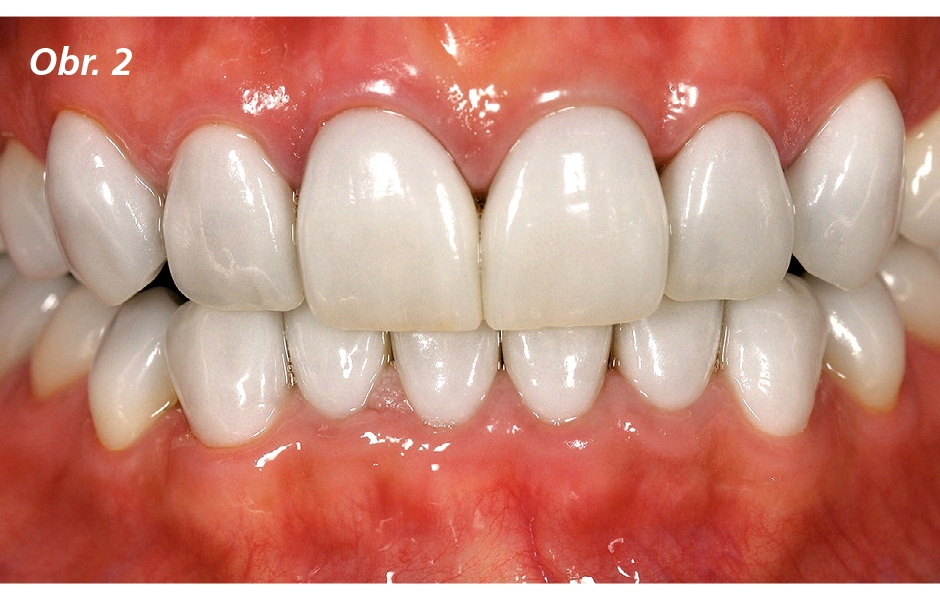 První případ – silně diskolorované zuby rekonstruované pomocí keramických fazet (IPS e.max Press)