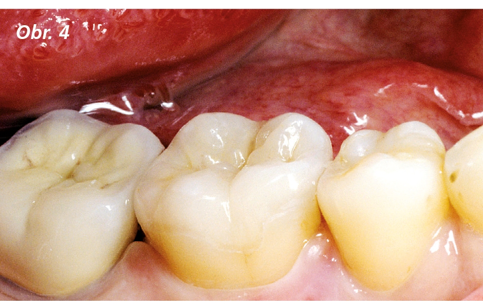 Druhý případ – po odlomení distálního hrbolku byl zub rekonstruován pomocí keramických materiálů. Po uvážení okluzních žvýkacích sil jsme se rozhodli použít vysoce pevnou keramiku IPS e.max Press LS2 ve spojení s technikou probarvování (výroba náhrady: zu