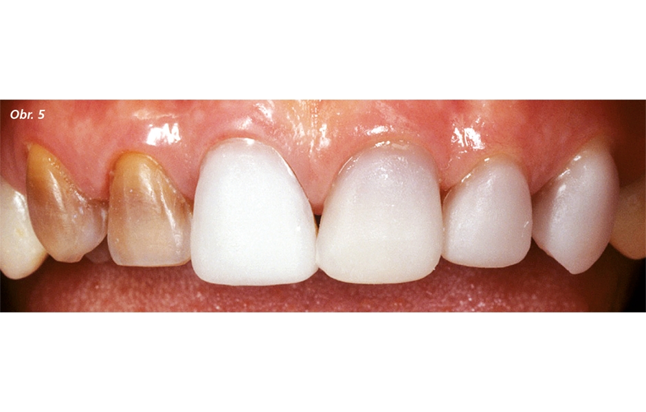 Třetí případ – zub 21 při zkoušce náhrady v ústech s kapkou vody.