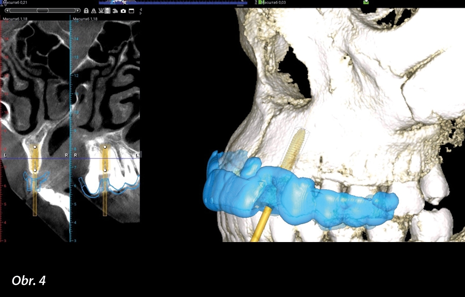 Digitální plánování implantátu a chirurgické šablony v softwaru Planmeca Romexis.