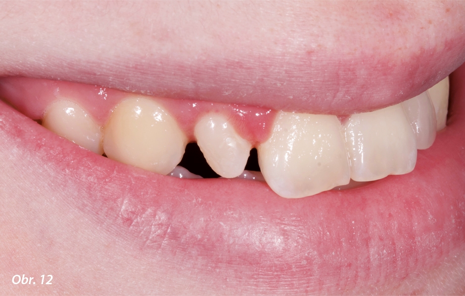 U zubu 12 bylo provedeno prodloužení korunky.