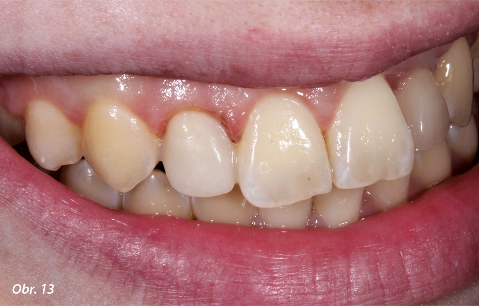 U zubu 12 bylo provedeno prodloužení korunky.