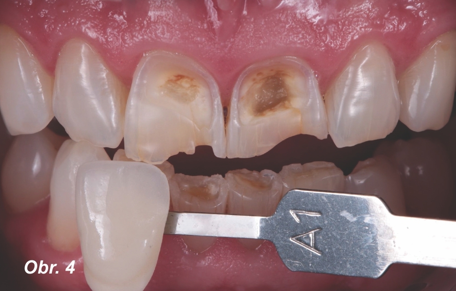 Barvu zubů jsme vybrali podle vzorníku VITA classical A1–D4®, a to odstín A1, který odpovídá stejnému odstínu materiálu 3M™ Filtek™ Universal