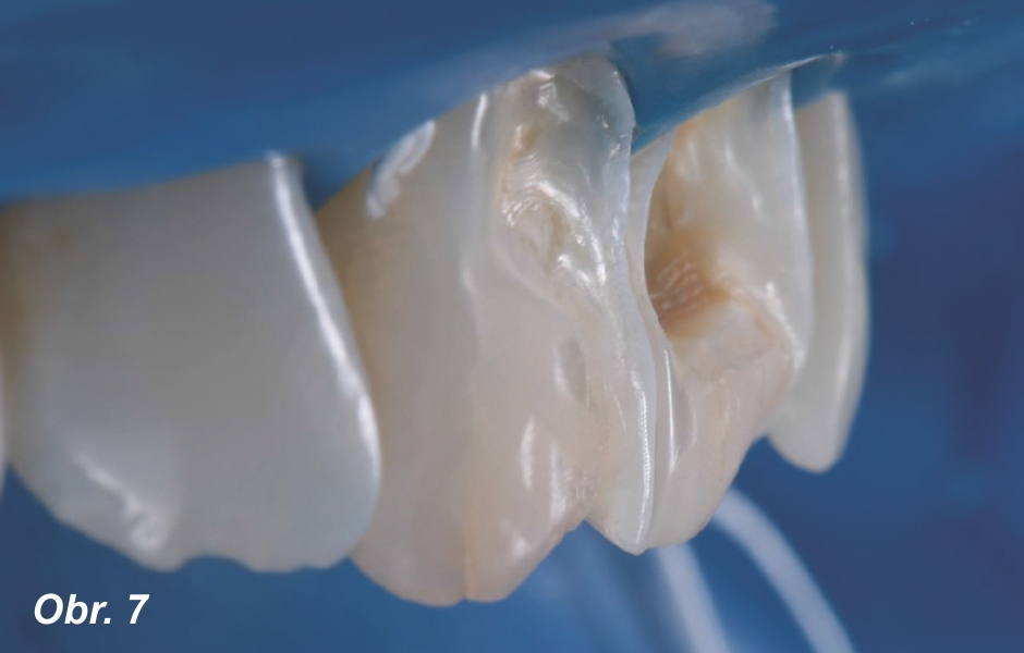 Preparované zuby při pohledu z boku