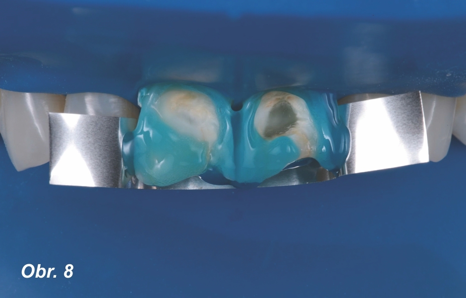 Sklovinu jsme naleptali pomocí 3M™ Scotchbond™ Universal Etchant po dobu 15 sekund – k ochraně okolních zubů jsme použili kovovou matrici