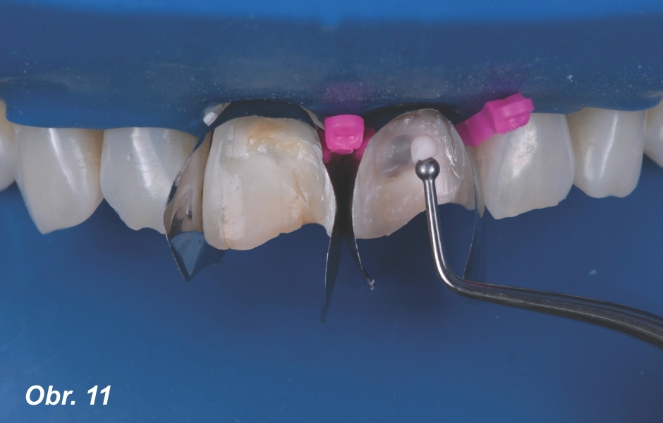 Na povrch diskolorovaného sklerotického dentinu jsme nanesli 1 mm silnou vrstvu materiálu Pink Opaquer (PO) tak, abychom maskovali všechna tmavá místa, a světelně jej polymerovali po dobu 20 s