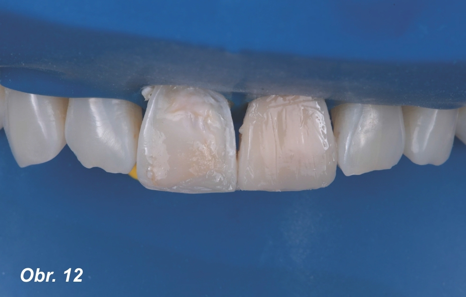 Pohled na ošetřované zuby po aplikaci první vrstvy 3M™ Filtek™ Universal odstínu A1: díky použití materiálu Pink Opaquer nebylo nutné použít k maskování sklerotického dentinu žádné jiné odstíny