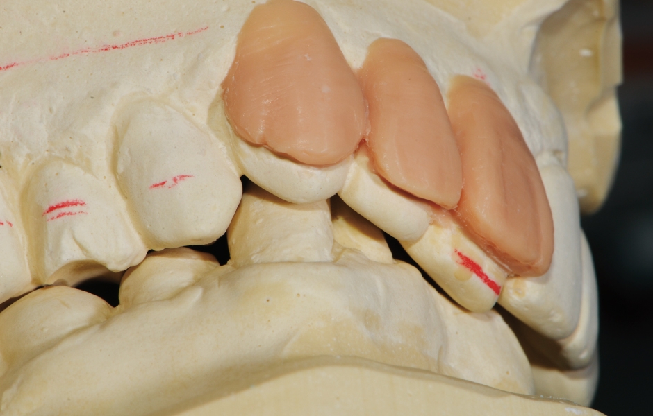 Obr. 11–13: Wax-up: nová pozice horních frontálních zubů (posun incizí o 8 mm ventrálně), pravý dolní špičák byl výchozím pro novelizaci dolní okluzní roviny.