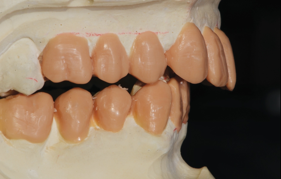 Obr. 11–13: Wax-up: nová pozice horních frontálních zubů (posun incizí o 8 mm ventrálně), pravý dolní špičák byl výchozím pro novelizaci dolní okluzní roviny.