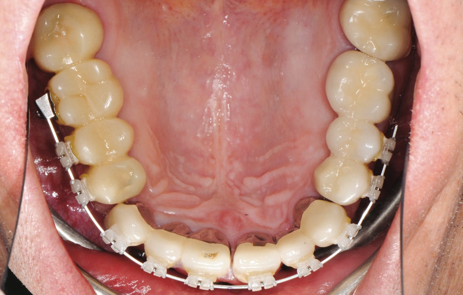 Obr. 14–15: K provizorním korunkám v horní čelisti je připevněn fixní oblouk korigující postavení řezáků, parciální fixní oblouky upravují pozici dolních laterálních zubů.