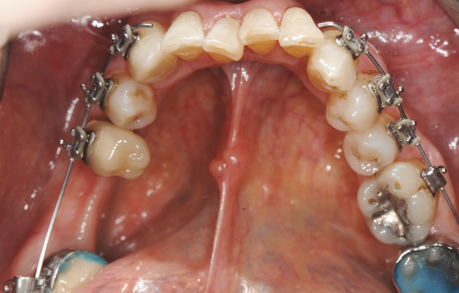 Obr. 14–15: K provizorním korunkám v horní čelisti je připevněn fixní oblouk korigující postavení řezáků, parciální fixní oblouky upravují pozici dolních laterálních zubů.