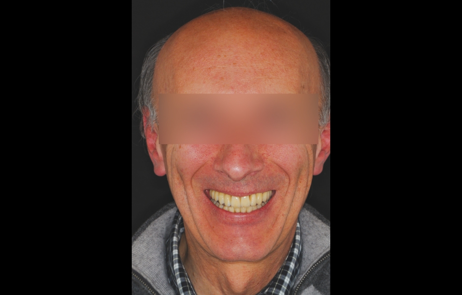 Obr. 28–31: Intraorální situace a fotografie úsměvu 6 měsíců po ortognátní operaci.