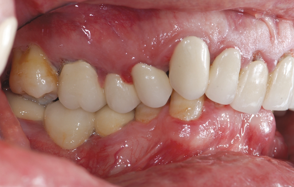 Obr. 5–7: Závažný hluboký skus vzniklý supraokluzí horních a dolních frontálních zubů.