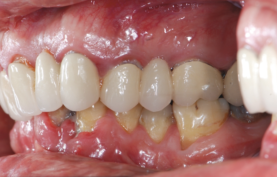 Obr. 5–7: Závažný hluboký skus vzniklý supraokluzí horních a dolních frontálních zubů.
