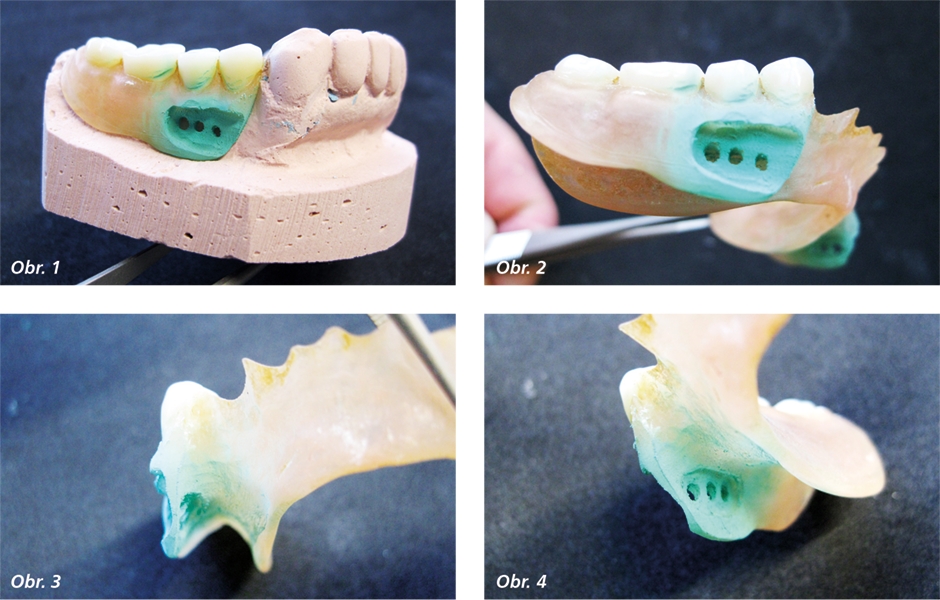 Specificky vybroušený prostor v polyamidové bázi pro novou drátěnou sponu  Náhrady na fotografiích v článku:  báze – Deflex (CompleteDental s.r.o.);  zuby – MAJOR SUPER LUX (FLAVA s.r.o.)