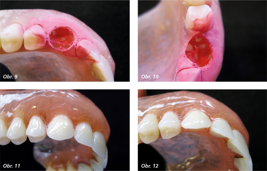 Specificky vybroušená retenční kavita v místě uvolněného/poškozeného konfekčního zubu a hotová oprava – upevnění konfekčního zubu pryskyřicí v polyamidové bázi