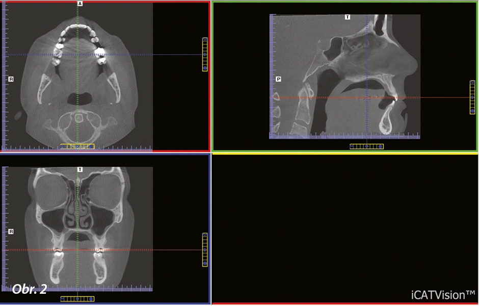 Software CBCT umožňuje zhotovit axiální, koronální a sagitální řez