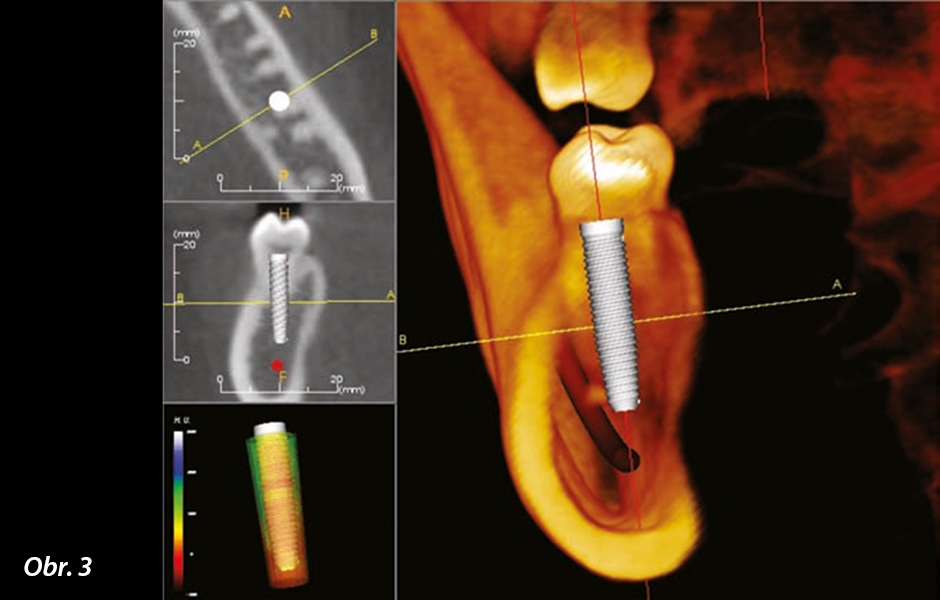 CBCT sken (i-CAT), jak je viditelný v softwaru pro 3D plánování (InVivoDental) (obrázek publikován se svolením Anatomage)