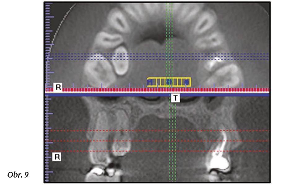 CBCT nabízí přesnou lokalizaci retinovaných zubů ve třech rozměrech