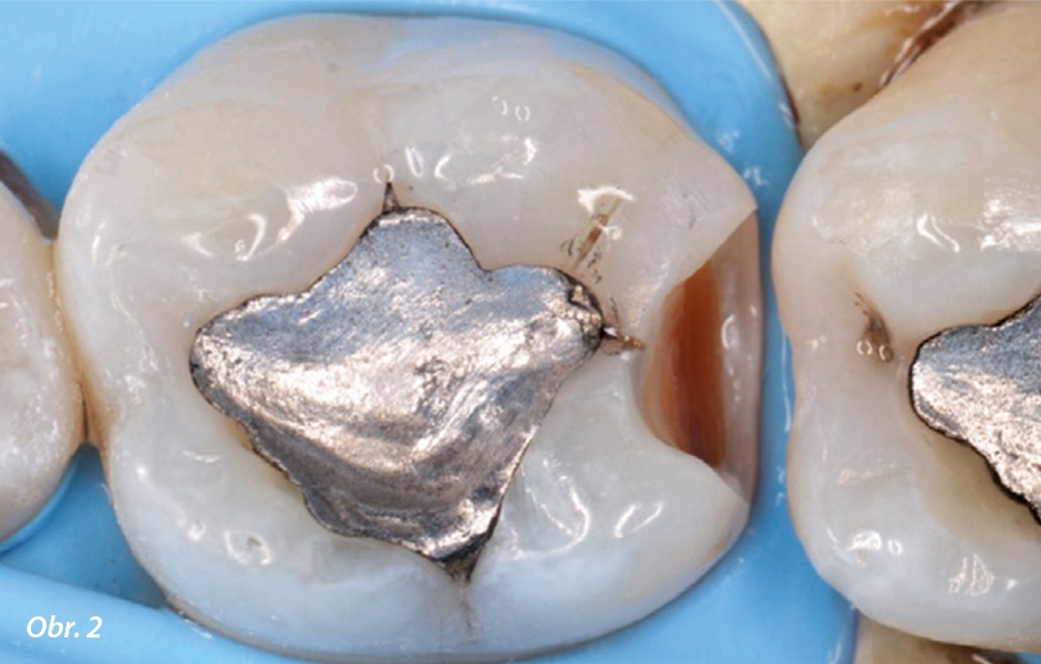 Přístupová kavita na zubu 36 se zbytky kazivé léze pro ošetření aproximálního kazu na zubu 37