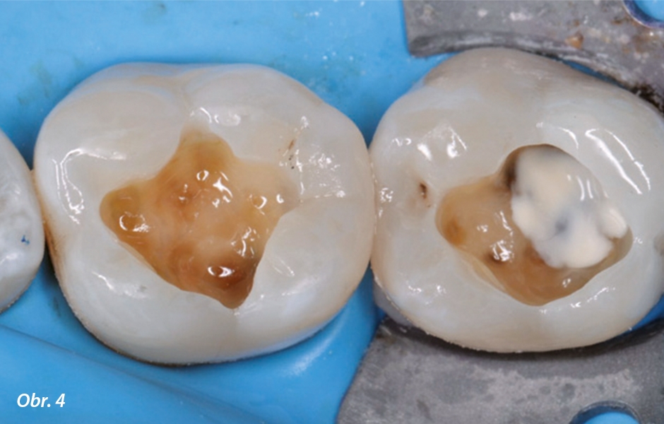 Situace po exkavaci kazů a adhezivní přípravě – na zub 37 byl aplikován opakní flow materiál k zakrytí tmavého dna