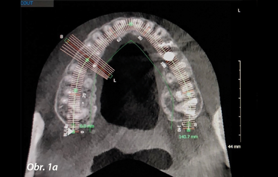 Obr. 1a: Před zákrokem byl pořízen CBCT sken.