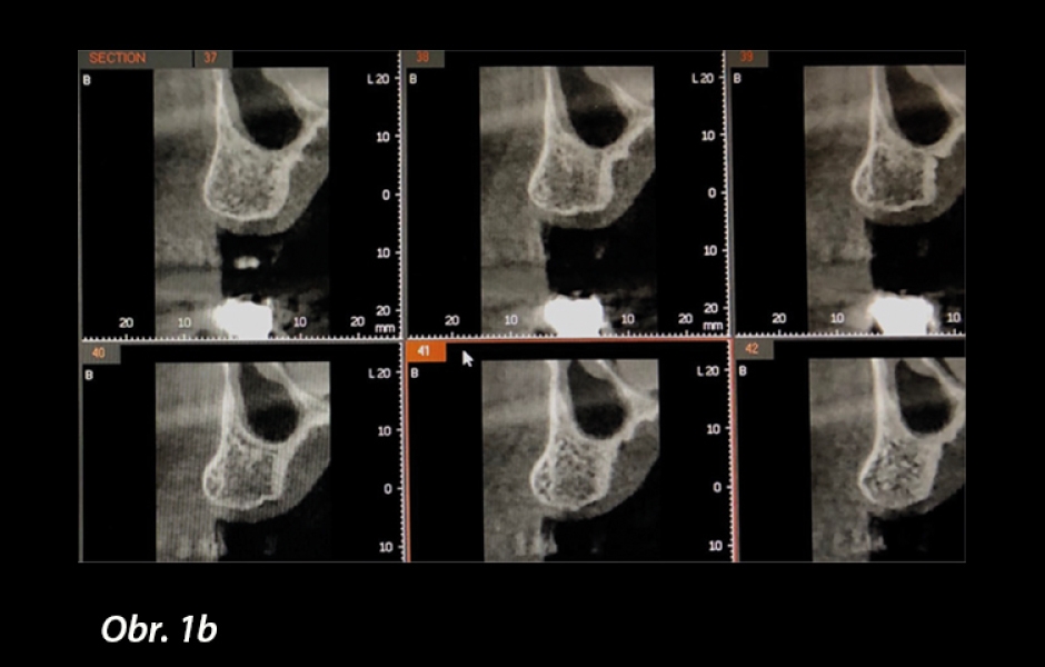 Obr. 1b: Před zákrokem byl pořízen CBCT sken.