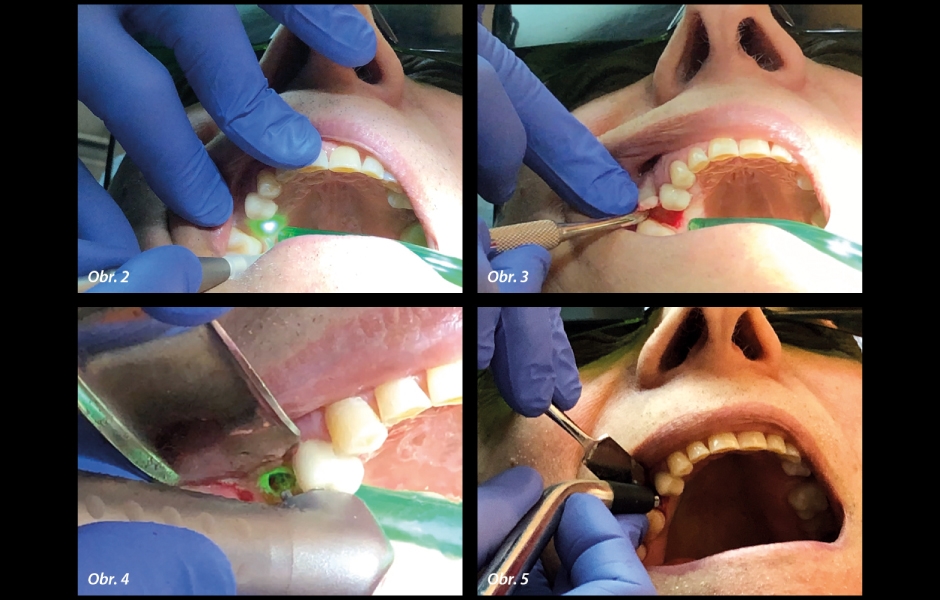 Obr. 2: „Incize“ laloku pomocí laserové hlavice LightWalker. Obr. 3: Odklopení laloku Prichardovým elevátorem. Obr. 4: Stabilizovaný laser preparující osteotomii. Obr. 5: Násadec Osstell detekující primární stabilitu.