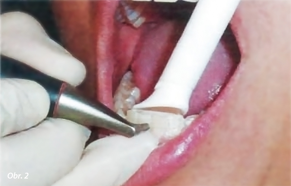 Naklonění v úhlu 60–90 ° k povrchu zubu