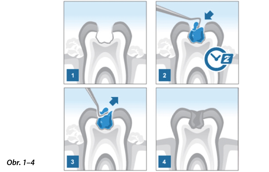 Obr. 1: Zubní kaz I. Bl. třídy. Obr. 2: Aplikace gelu BRIX3000® po dobu 2 minut. Obr. 3: Exkavace infikovaného dentinu. Obr. 4: Kavita po ošetření.