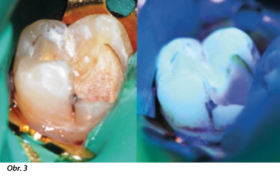 Obr. 3: Dosažení narušeného kožovitého dentinu – kontrola pohledem a za použití světelné fluorescence. 