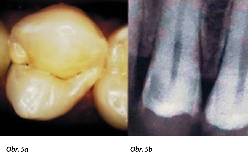 Obr. 5: a) Intraorální snímek zubu 24. b) RTG snímek zubu 24 zachycující meziálně se nacházející rozsáhlý kariézní defekt v blízkosti zubní dřeně.