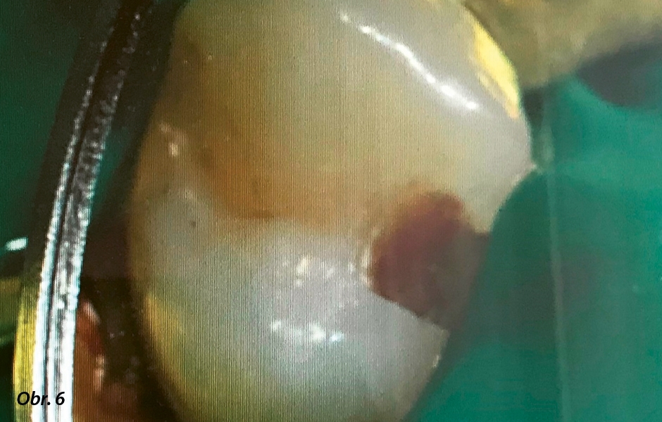 Obr. 6: Detekce kazu směřovala na meziální oblast zubu 24, kde je vidět světležlutý kariézní dentin.