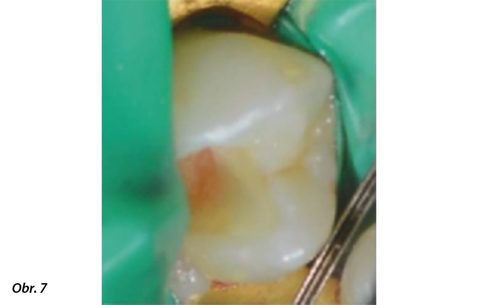 Obr. 7: Zub 24 po finálním odstranění kariézního dentinu – povrch je relativně hladký.
